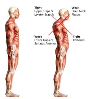 Crossed Syndrome