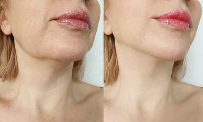 reduce face fat