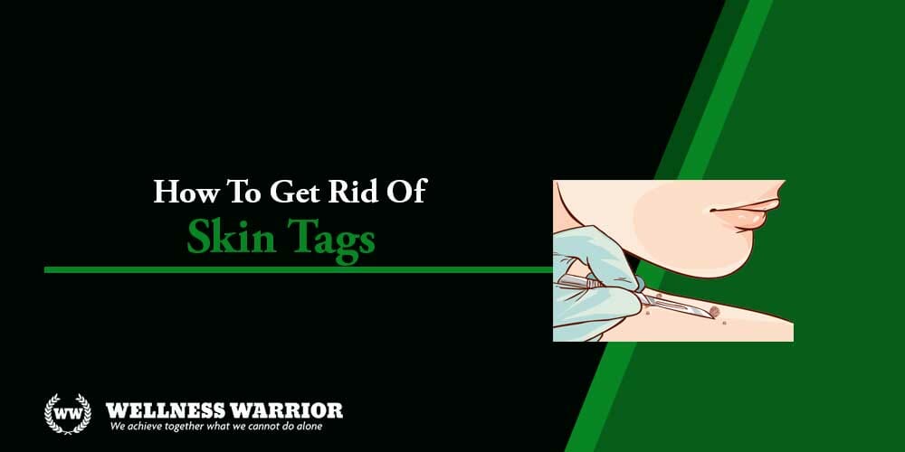 How to get rid of skin tags