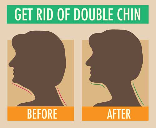 double chin surgery