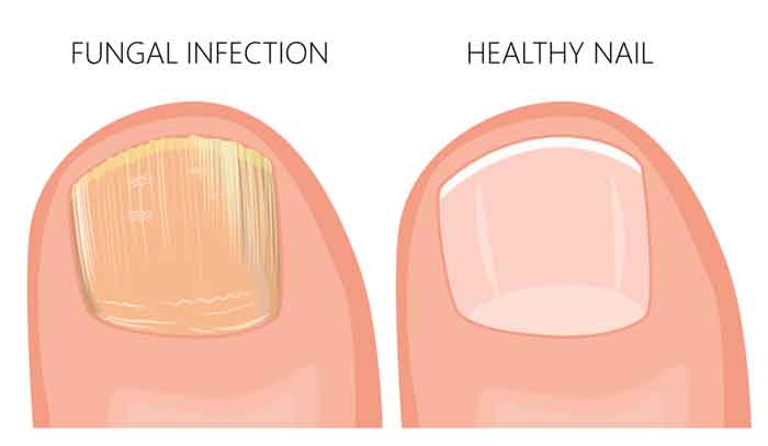 toenails