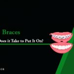 how long does it take to put on braces