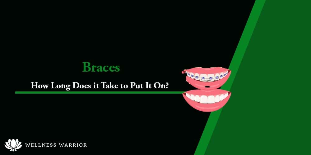 How Long Does it Take to Put on Braces?