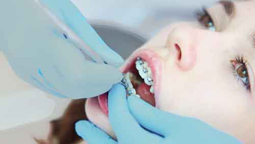lady putting on dental braces